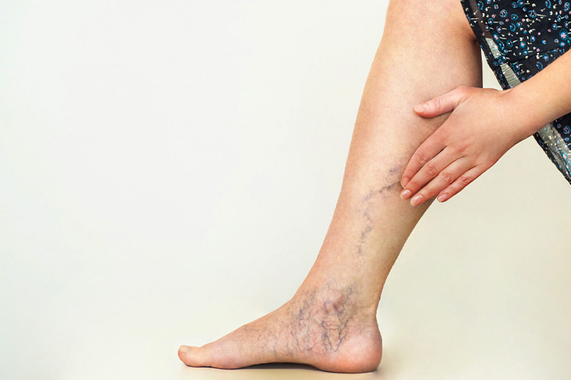 بررسی و تشخیص و درمان علل عروقی ورم پا