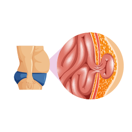 فتق شکمی 